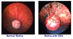 Normal retina és CEA